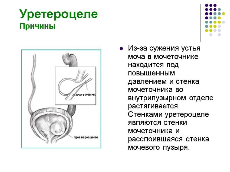 Уретероцеле Причины Из-за сужения устья моча в мочеточнике находится под повышенным давлением и стенка